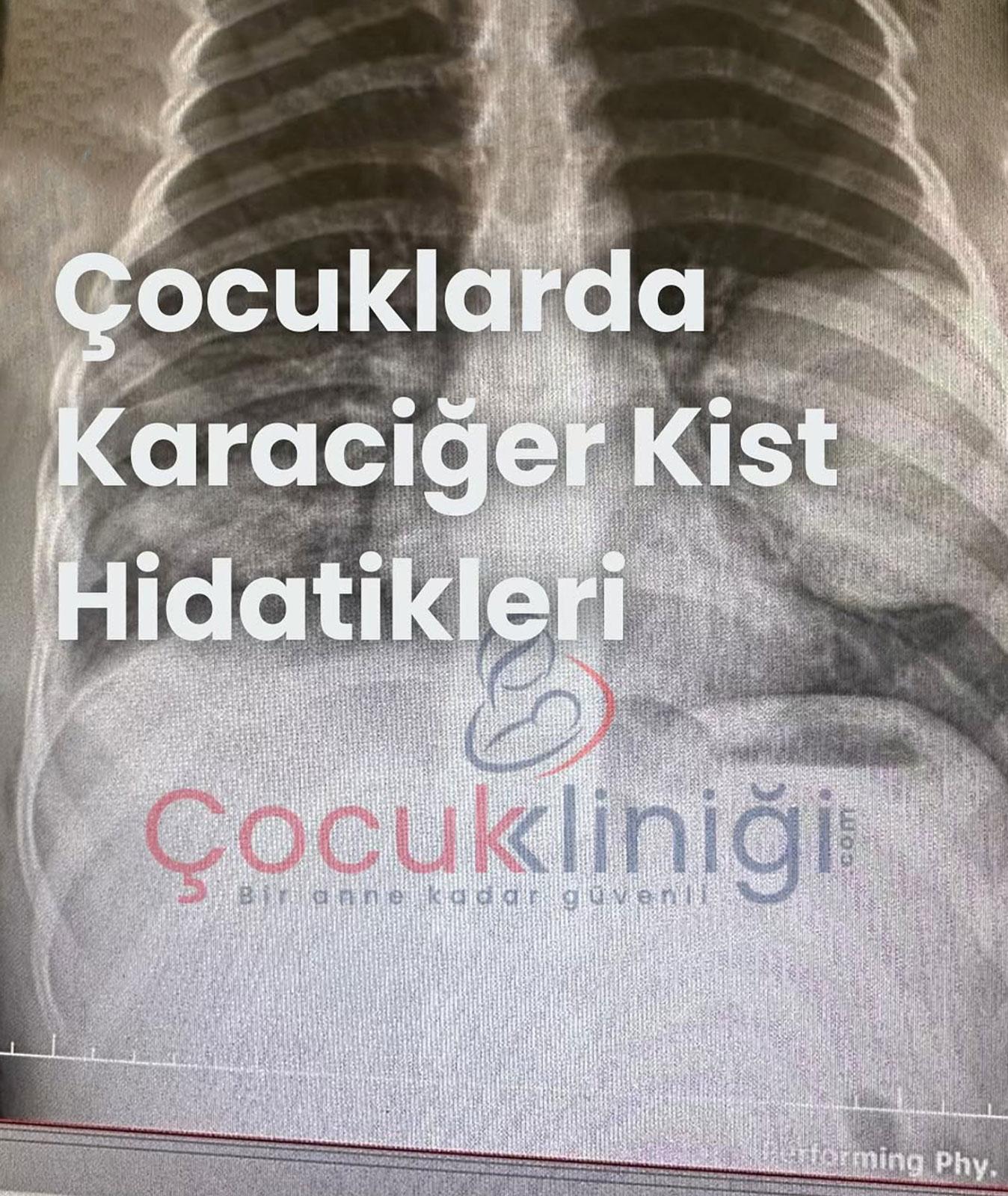 Çocuklarda Karaciğer Kist Hidatikleri