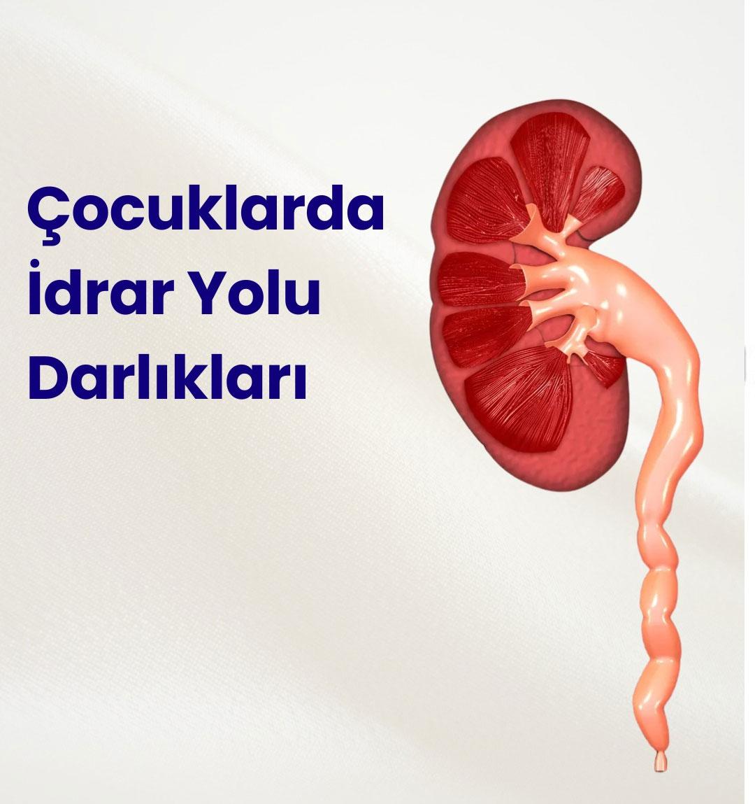 Çocuklarda İdrar Yolu Darlıkları