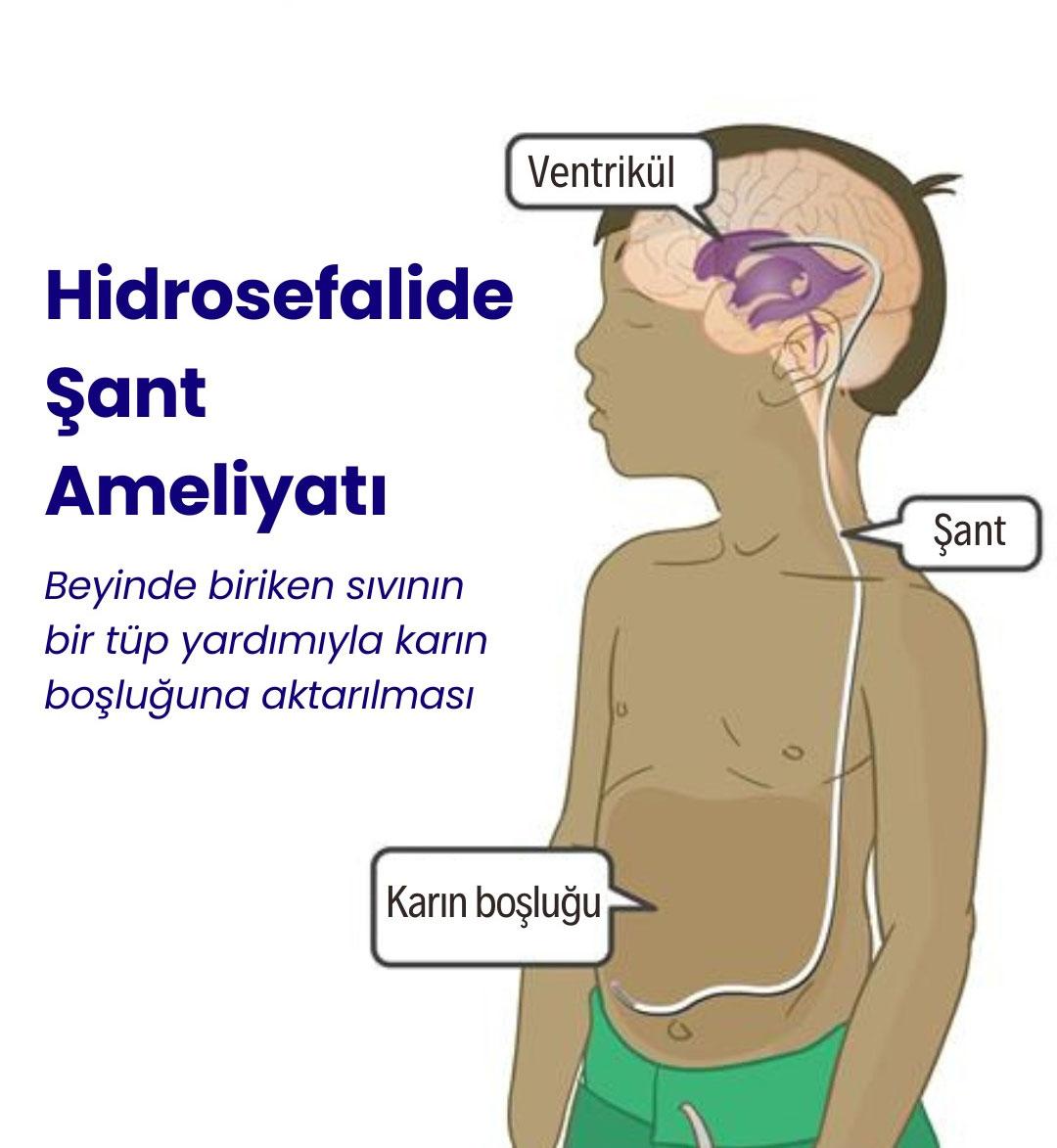 Hidrosefalide Şant Ameliyatı