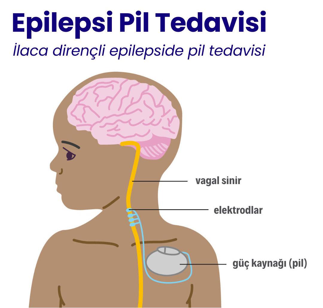 Epilepsi Pil Tedavisi